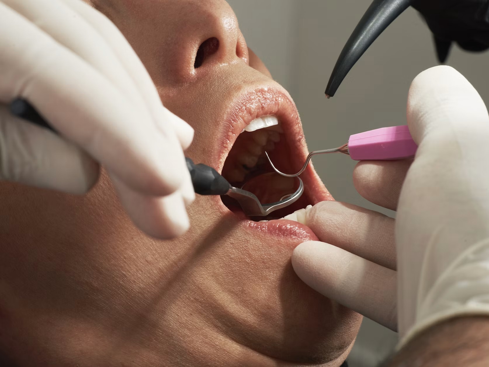 Dentist examining a patient's teeth with a mirror and probe