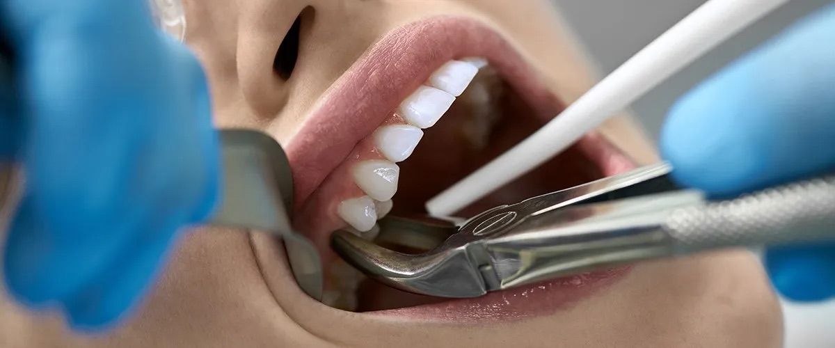 Dentist using forceps during a tooth extraction