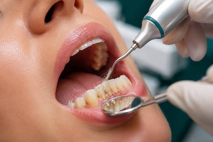 Ultrasonic scaler cleaning plaque and tartar from a patient's teeth